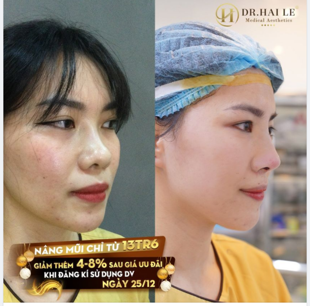 "Muốn có mũi đẹp để Tết đi chơi thì tầm này nâng là chuẩn xinh rồi"