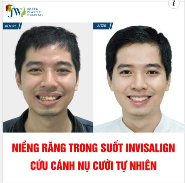 NÂNG CẤP NỤ CƯỜI 360 ĐỘ NHỜ NIỀNG TRĂNG TRONG SUỐT INVISALIGN