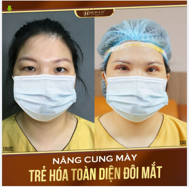 NÂNG CUNG MÀY - TRẺ HÓA ĐÔI MẮT, LẤY LẠI THANH XUÂN