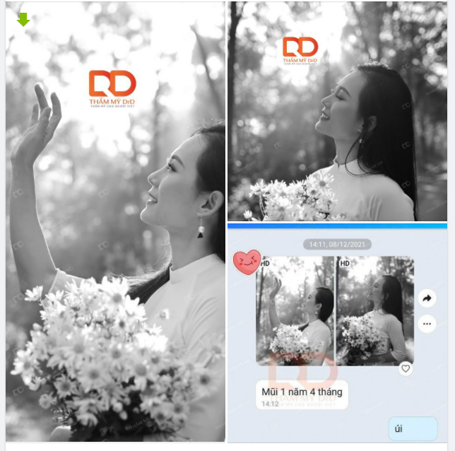Nâng mũi 1 năm 4 tháng, tự tin khoe dáng