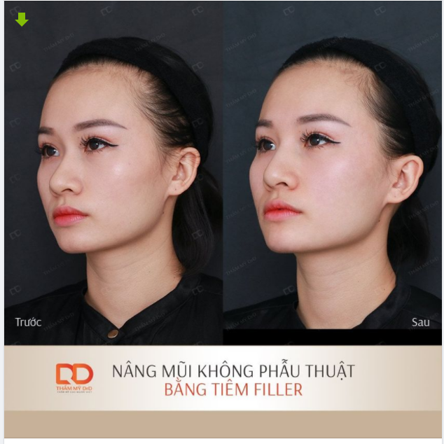 Nâng mũi bằng Filler - Phương pháp làm đẹp dành cho ai không thích can thiệp phẫu thuật.