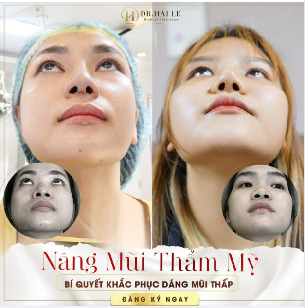 NÂNG MŨI, ĐẨY CAO ĐẦU MŨI - Tạo hình lỗ mũi hạt chanh duyên dáng.!