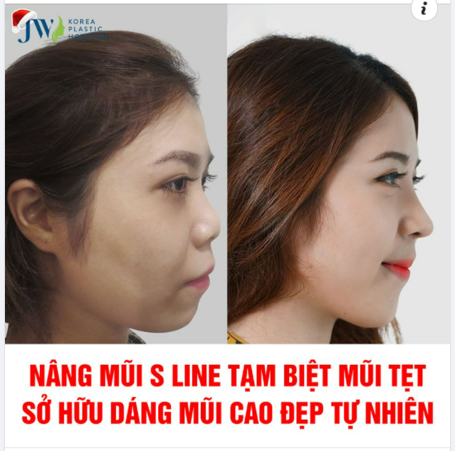 NÂNG MŨI S LINE TẠM BIỆT MŨI TẸT SỞ HỮU DÁNG MŨI CAO ĐẸP TỰ NHIÊN