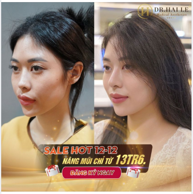Nâng mũi tại Dr.Hải Lê chi phí CHỈ TỪ 13TR6 trong khi GIÁ GỐC CỦA CHÚNG TỪ 28TR - 75TR Dẹp tan nỗi lo chi phí.