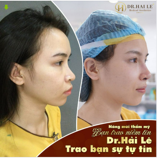 NÂNG MŨI THẨM MỸ - NÂNG TẦM NHAN SẮC.!!