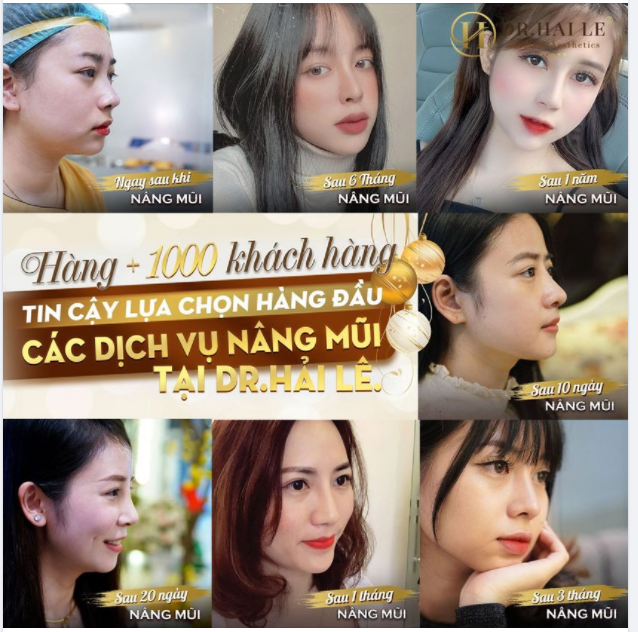 Nâng mũi thẩm mỹ - Tin tưởng lựa chọn Dr.Hải Lê để "Trao mặt gửi vàng".!