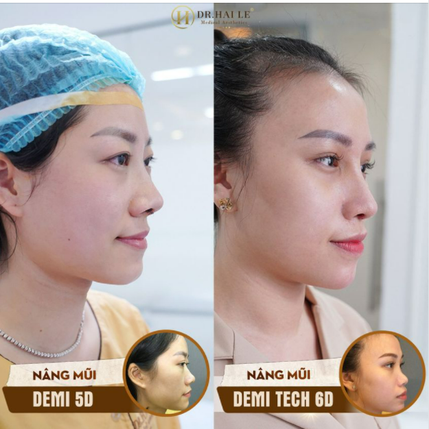 NÂNG MŨI THẨM MỸ - TỰ TIN TRONG MỌI KHUÔN HÌNH.!!