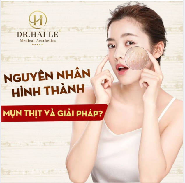 NGUYÊN NHÂN HÌNH THÀNH MỤN THỊT VÀ GIẢI PHÁP!