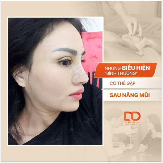 Những biểu hiện "bình thường" có thể gặp sau phẫu thuật Nâng mũi