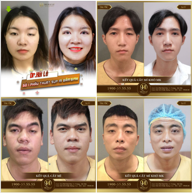 Những ca Cắt mí siêu khó nhưng mang tới kết quả siêu đẹp nhờ Cắt mí khó MK.