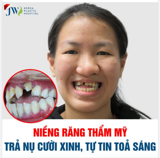 NIỀNG RĂNG THẨM MỸ - TRẢ NỤ CƯỜI XINH, TỰ TIN TOẢ SÁNG