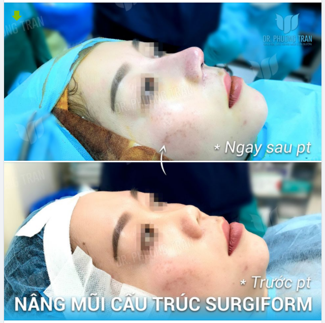 ÔI, MUỐN NGẮM CHIẾC MŨI NÀY MÃI THÔI!