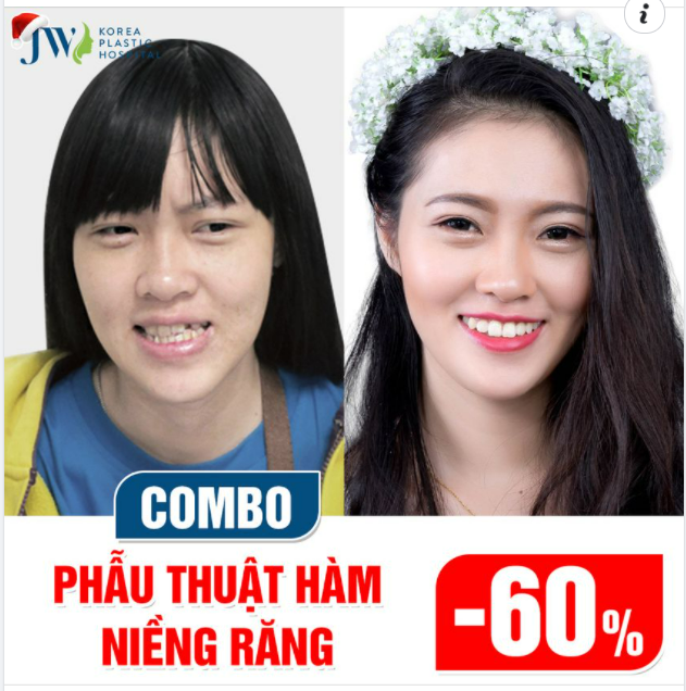 ÔI THẬT BẤT NGỜ! MIỄN PHÍ 60% COMBO PHẪU THUẬT HÀM-NIỀNG RĂNG