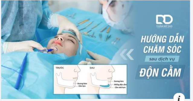 Phẫu thuật độn cằm ngày càng được các chị em ưa chuộng bởi khả năng tạo gương mặt Vline thanh tú.