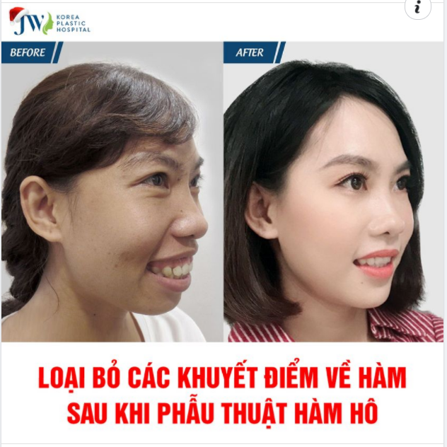 PHẪU THUẬT HÀM HÔ THỊ NỞ CŨNG HÓA NÀNG THƠ