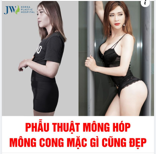 PHẪU THUẬT MÔNG HÓP ÚM BA LA RA MÔNG ĐÀO QUYẾN RŨ