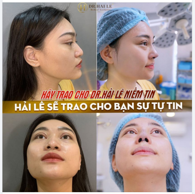 PHẪU THUẬT NÂNG MŨI CÓ DUY TRÌ TRỌN ĐỜI ĐƯỢC KHÔNG?