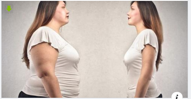 Phẫu thuật – thêm một giải pháp cho người béo phì