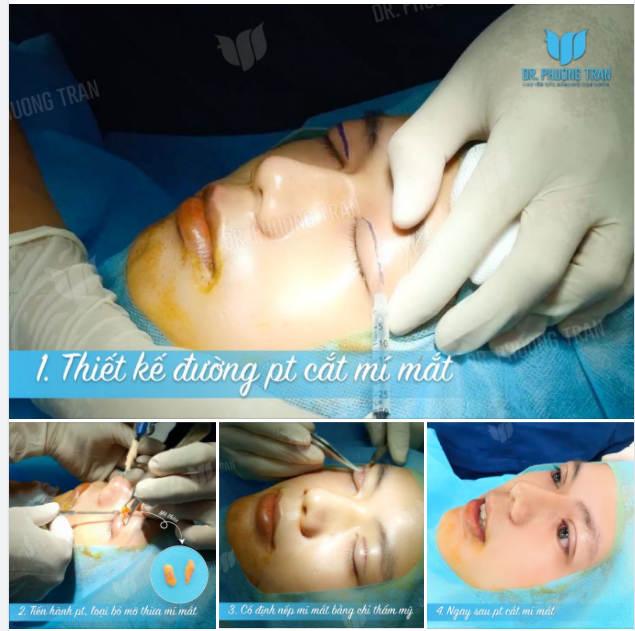 QUY TRÌNH 3 BƯỚC NHANH- GỌN - HIỆU QUẢ TẠO 2 MÍ