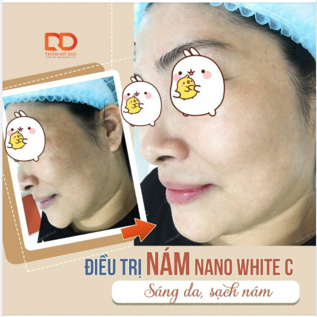 SẠCH NÁM, SÁNG DA, NGĂN NGỪA LÃO HÓA
