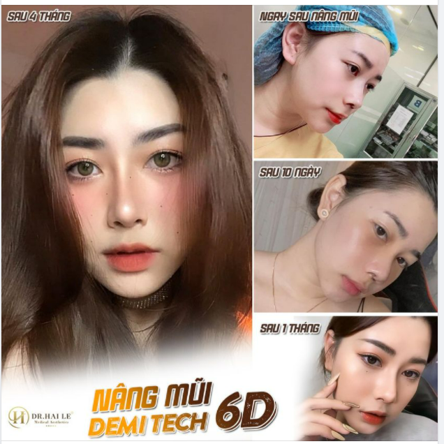 Siêu phẩm nâng mũi Demi Tech 6D tại Dr.Hải Lê - không thể bỏ lỡ