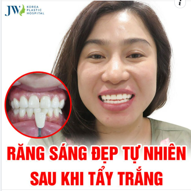 SỞ HỮU HÀM RĂNG TRẮNG SÁNG TỰ NHIÊN NHỜ TẨY TRẮNG RĂNG TẠI KHOA RĂNG HÀM MẶT BỆNH VIỆN JW