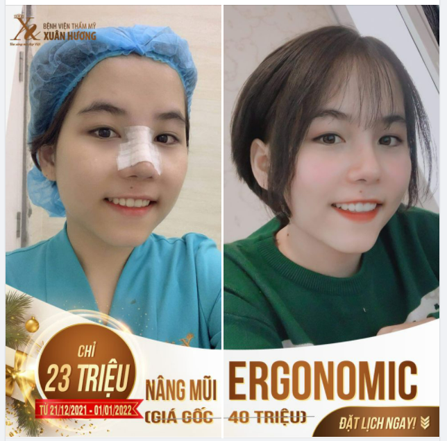 Sở hữu mũi xinh như hotgirl không khó - Đừng bỏ lỡ ưu đãi cuối năm siêu xịn