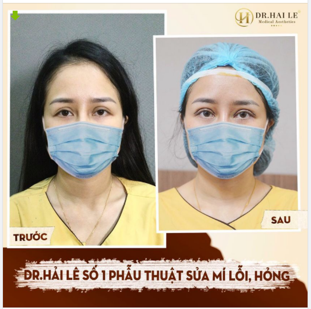 SỬA MÍ DEEP TECH20 - BẠN TRAO NIỀM TIN, DR.HẢI LÊ TRAO BẠN SỰ TỰ TIN.!!