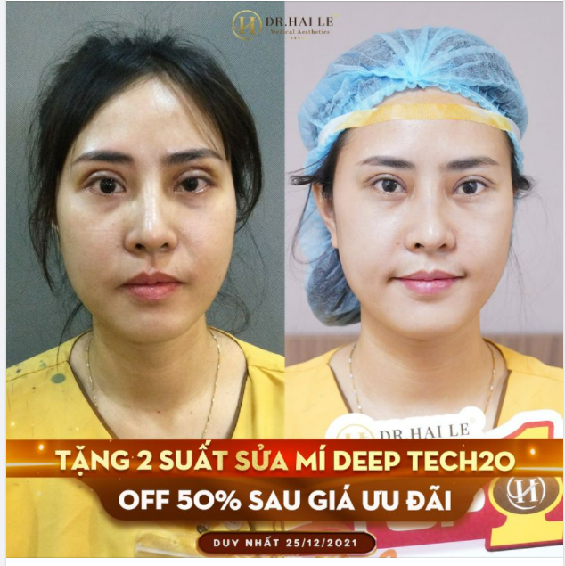 SỬA MÍ DEEP TECH20 - DR.HẢI LÊ SỐ 1 PHẪU THUẬT SỬA MÍ LỖI, HỎNG