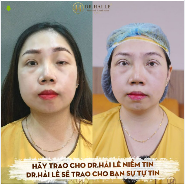 SỬA MÍ “XẤU, HỎNG” DEEP TECH- DR.HẢI LÊ LÀ ĐỊA CHỈ SỐ 1