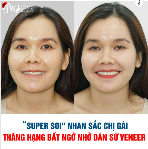“SUPER SOI" NHAN SẮC CHỊ GÁI THĂNG HẠNG BẤT NGỜ NHỜ MẶT DÁN SỨ