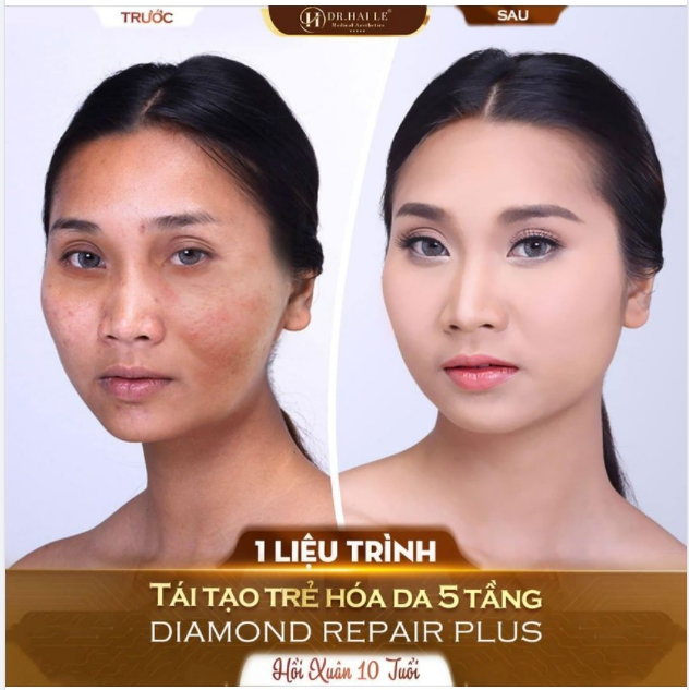 TÁI TẠO TRẺ HÓA DA 5 TẦNG DIAMOND REPAIR PLUS GIẢI CỨU GƯƠNG MẶT GIÀ - HỐC HÁC - NHIỀU NẾP NHĂN!