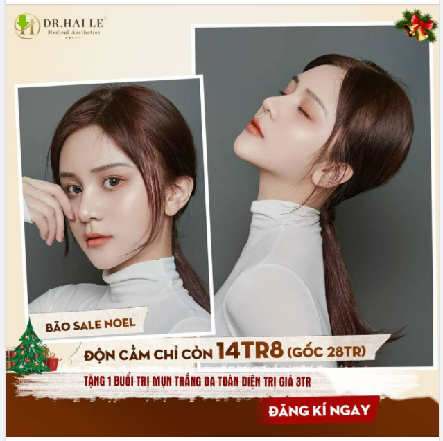 TẠO HÌNH CẰM V-LINE CHUẨN Y KHOA