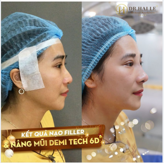 THẨM MỸ MŨI - NÊN TIÊM FILLER HAY NÂNG MŨI?