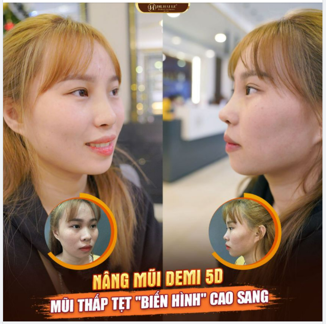 "THAY DÁNG MŨI - ĐỔI THẦN THÁI