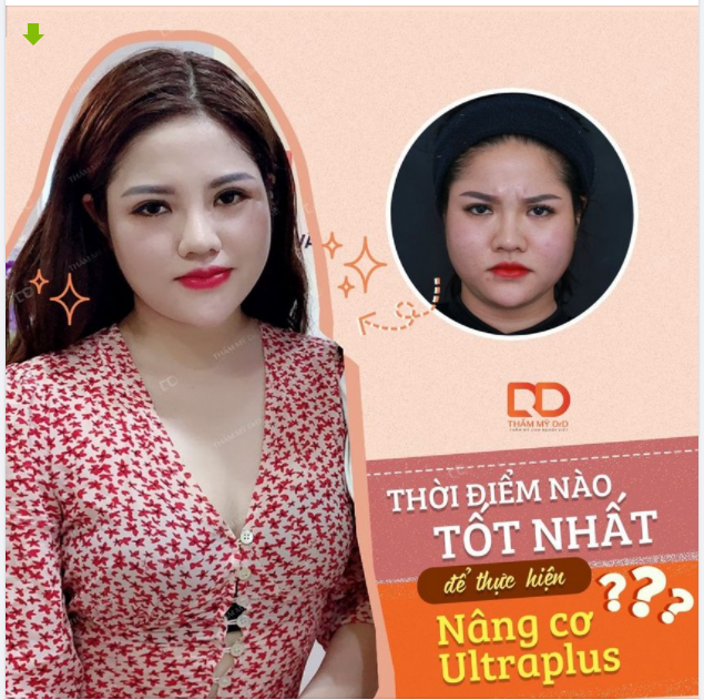 Thời điểm nào tốt nhất để thực hiện Nâng cơ Ultraplus?
