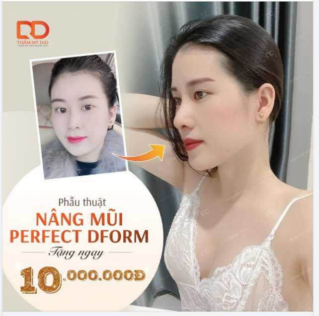 Tiếc nuối vì bỏ lỡ sale 12.12 thì đã có ngay ưu đãi Nâng mũi Perfect Dform