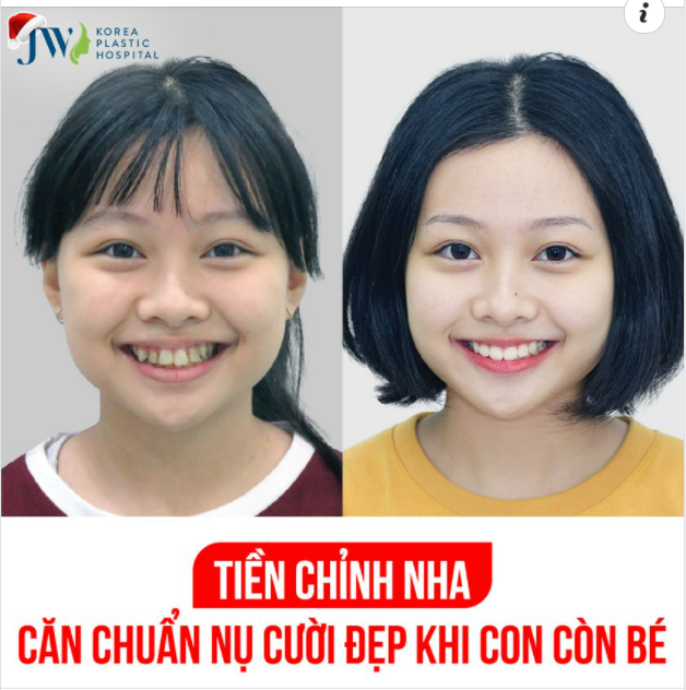 TIỀN CHỈNH NHA CĂN CHUẨN NỤ CƯỜI ĐẸP KHI CON CÒN BÉ