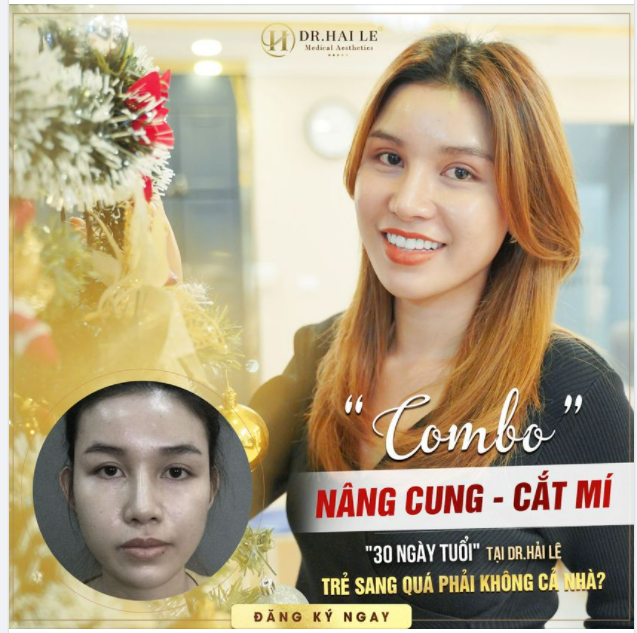 Tới Dr.Hải Lê thẩm mỹ mắt với combo CẮT MÍ - NÂNG CUNG MÀY. Chị đẹp review kết quả sau 1 tháng!