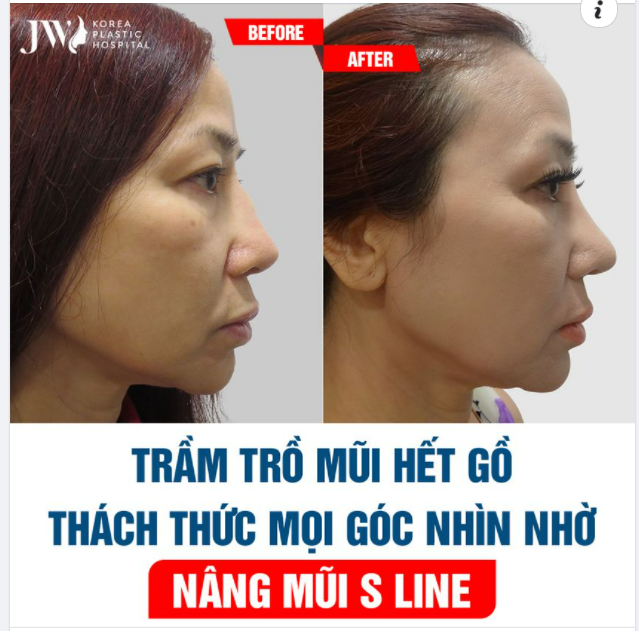 TRẦM TRỒ MŨI HẾT GỒ CHUẨN ĐẸP TỰ NHIÊN NHỜ NÂNG MŨI S LINE