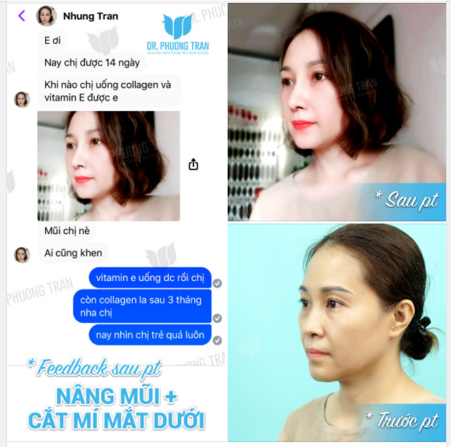 TRẺ RA 5 TUỔI NHỜ COMBO NÂNG MŨI + CẮT MÍ DƯỚI
