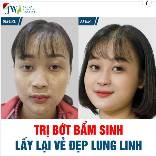 TRỊ BỚT BẨM SINH LẤY LẠI VẺ ĐẸP LUNG LINH