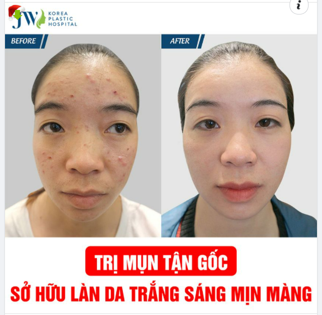 TRỊ MỤN TẬN GỐC LẤY LẠI LÀN DA MỊN MÀNG CHỈ CÓ TẠI BỆNH VIỆN JW
