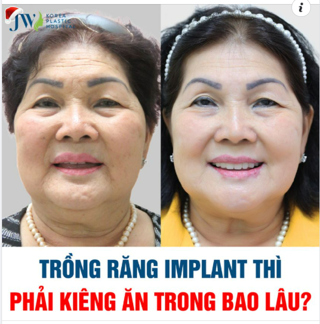 TRỒNG RĂNG IMPLANT THÌ PHẢI KIÊNG ĂN TRONG BAO LÂU?