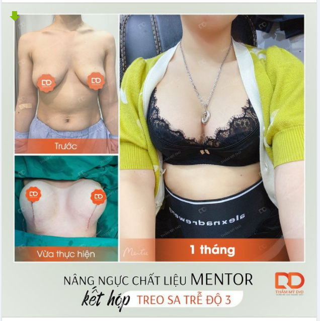 Trường hợp nào cần kết hợp treo sa trễ kết hợp đặt túi?