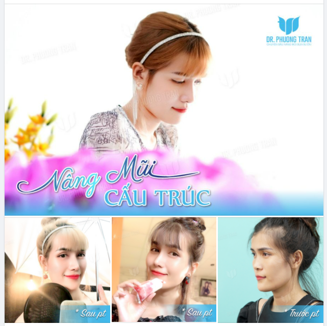 Vẻ đẹp “cực phẩm” của cô bạn sau nâng mũi cấu trúc. Chúc bạn một đời hạnh phúc!