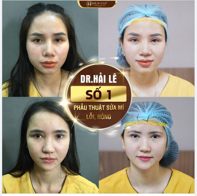 VÌ SAO DR.HẢI LÊ LÀ ĐỊA CHỈ SỐ 1 PHẪU THUẬT SỬA MÍ LỖI, HỎNG?