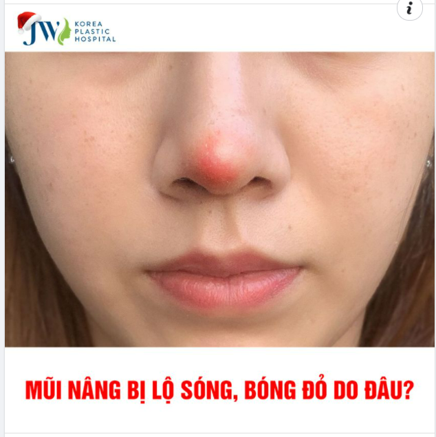VÌ SAO MŨI BỊ LỘ SÓNG, BÓNG ĐỎ SAU KHI NÂNG?