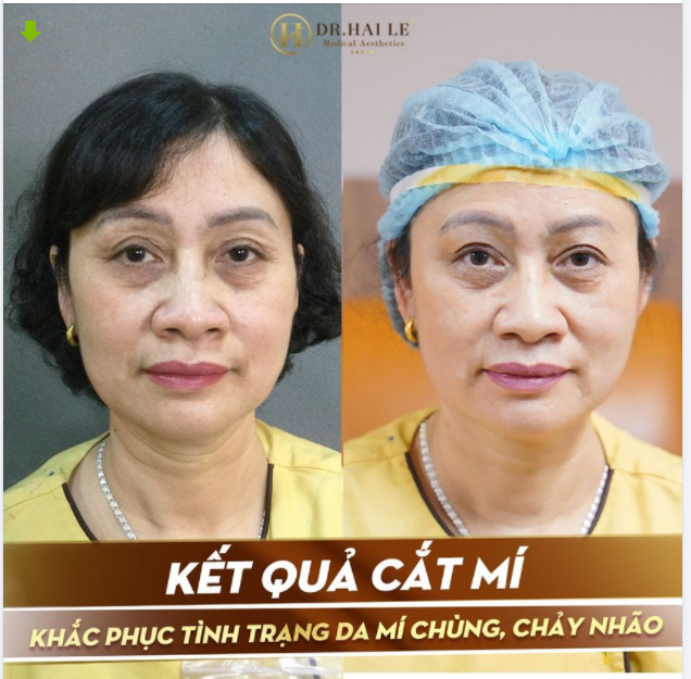 Xóa vết thời gian trên đôi mắt.!