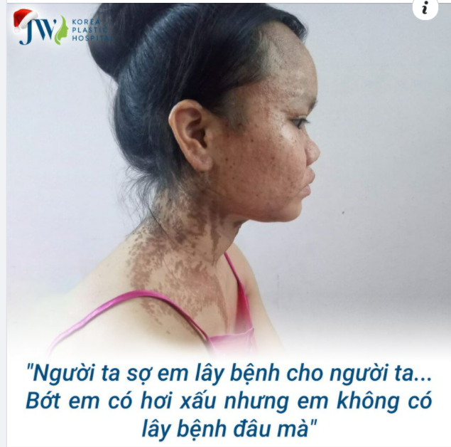 XÓT XA TRƯỚC SỐ PHẬN TRỚ TRÊU CỦA CÔ BÉ BỊ BỚT SẮC TỐ BẨM SINH